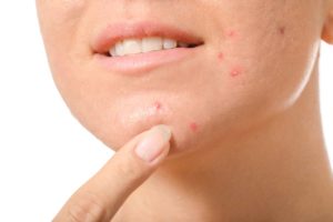 young woman with acne problem white closeup
