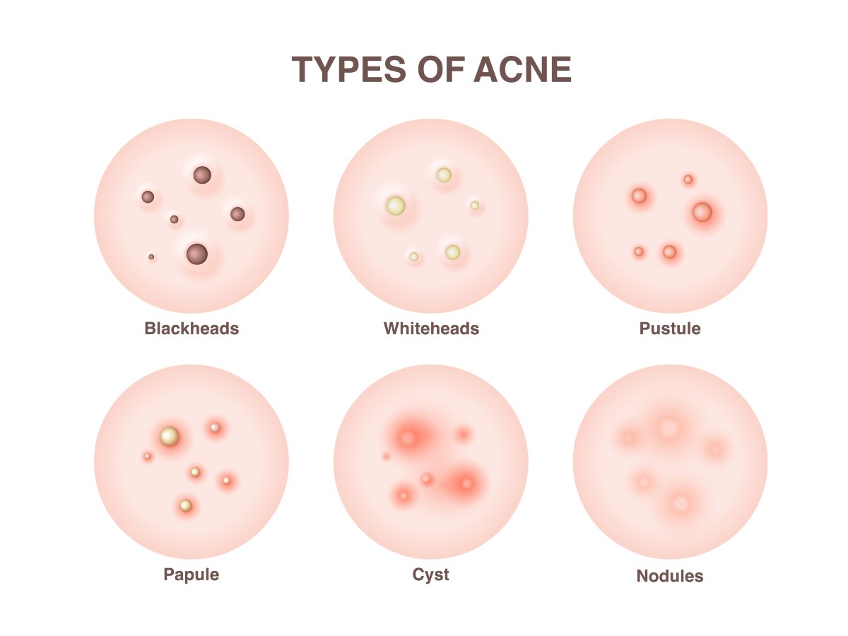 acne 1