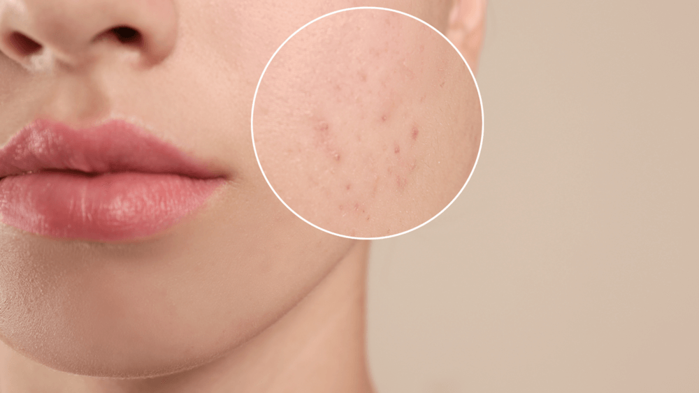 Teenage Girl with Acne Problem