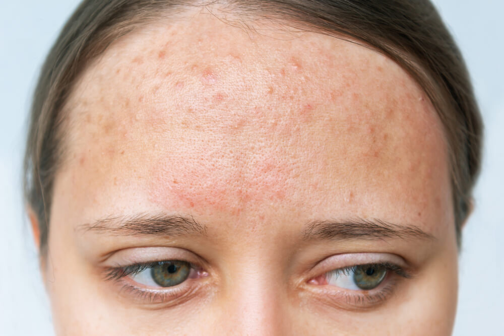 close up red rash forehead cropped shot young woman s face with acne problem allergy